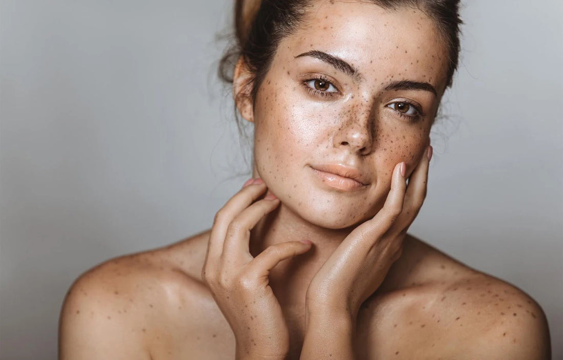 Best Freckle Treatment in Pakistan