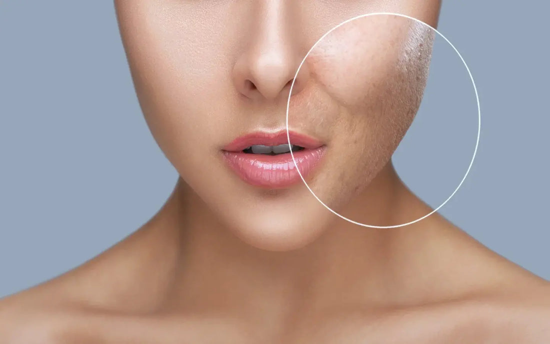 Best Open Pores Treatment in Pakistan