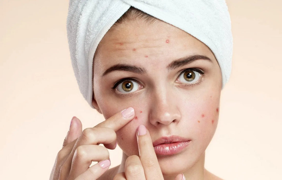 Understanding the Causes of Acne and Its Effective Treatments