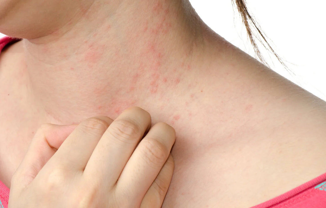 Understanding the Different Types and Symptoms of Dermatitis 
